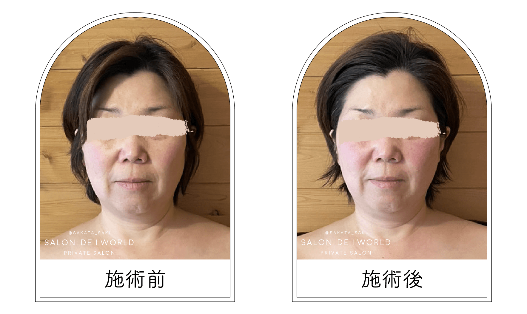 インディバビフォーアフター