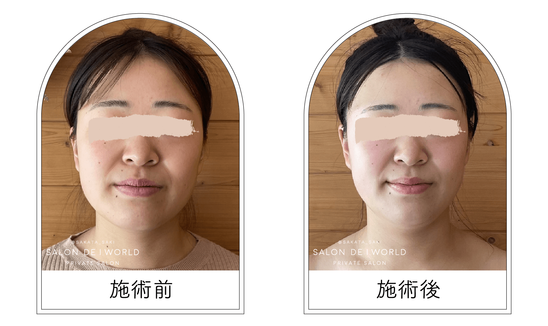 インディバビフォーアフター