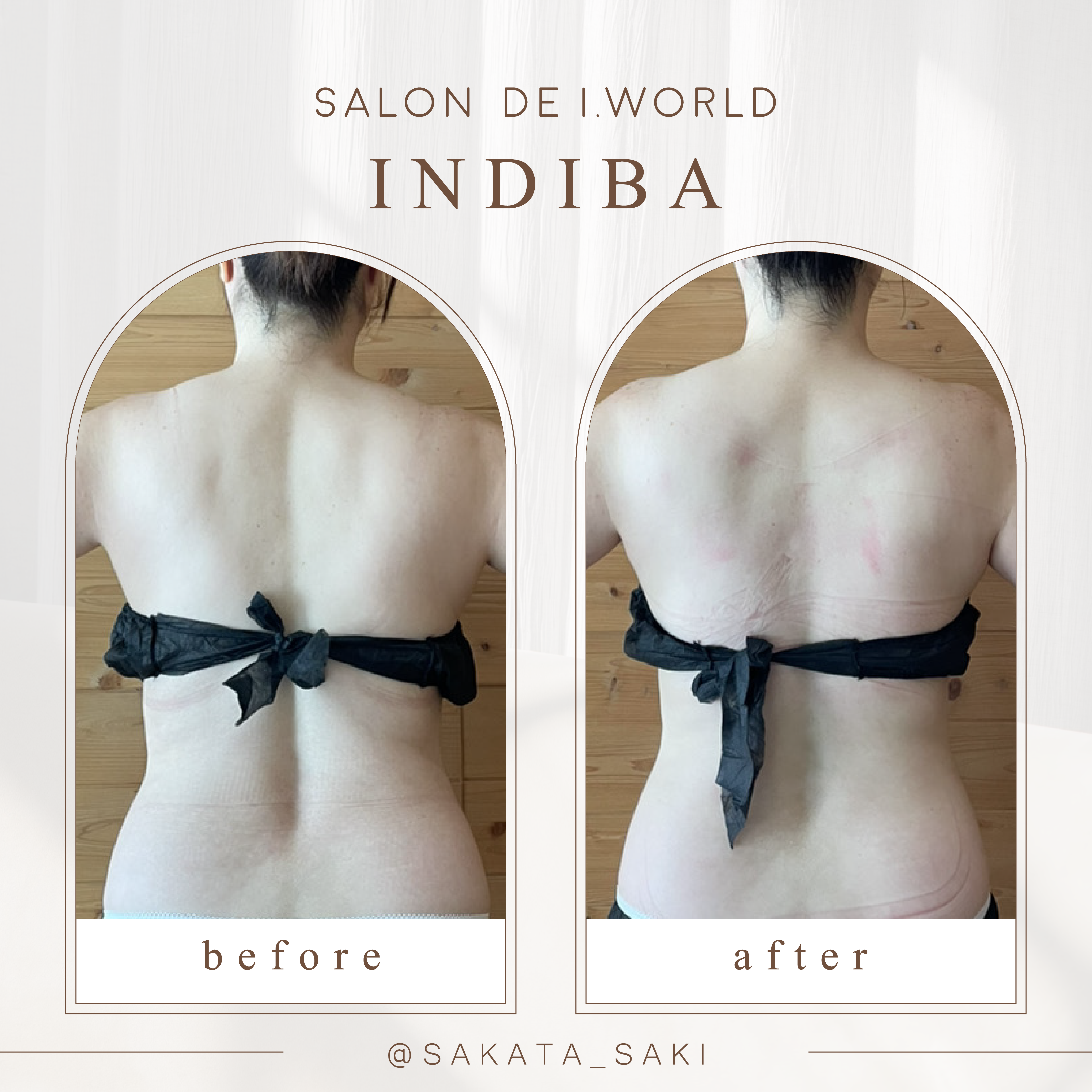 インディバビフォーアフター背中