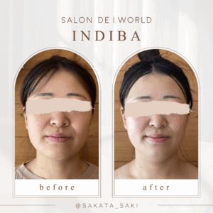 顔痩せビフォーアフター